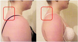 Formación dun rodillo muscular na osteocondrose cervical