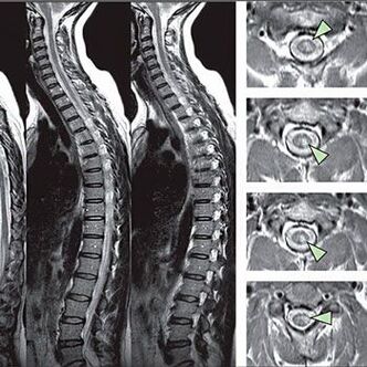 Diagnóstico de osteocondrose torácica