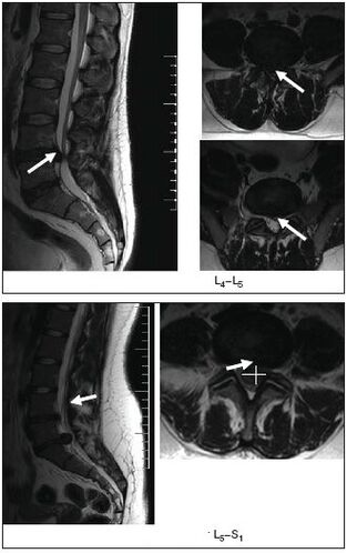 Exploración por resonancia magnética dun disco herniado na columna vertebral