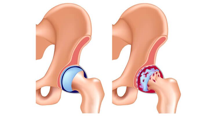 Articulación da cadeira sa e artrítica