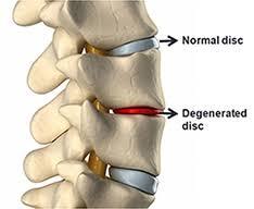 normal ROM da columna vertebral, o mal disco